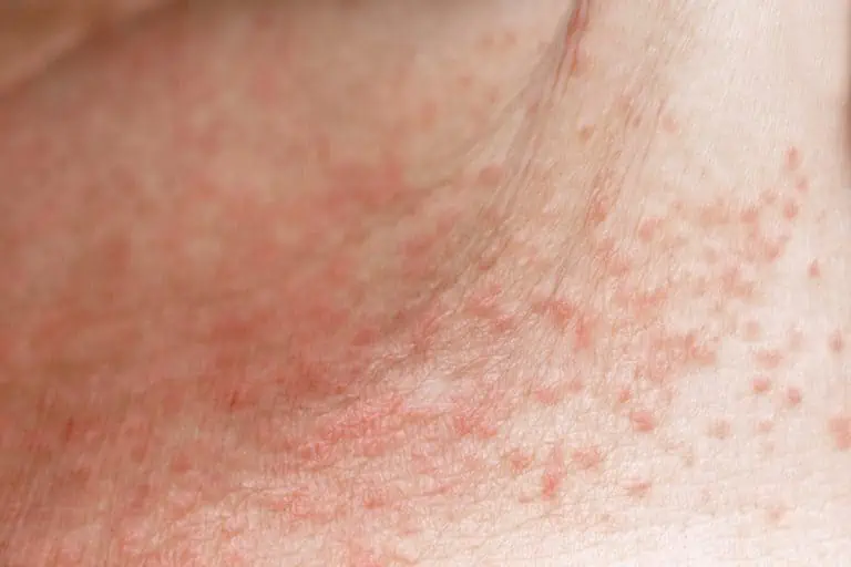 How to deal with heat rash, Skin Guides