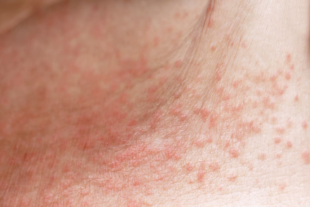 How To Get Rid Of Heat Rash Prickly Heat Riverchase Dermatology