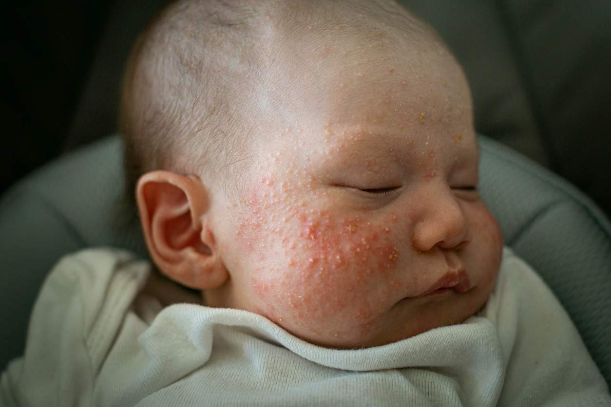 Baby Acne What Parents Need To Know Riverchase Dermatology