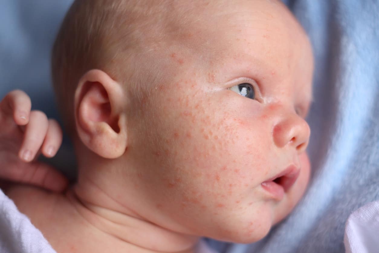 Baby Acne What Parents Need To Know Riverchase Dermatology