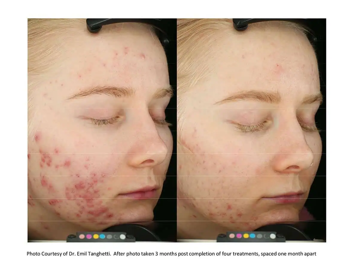 Accure before and after photo #3